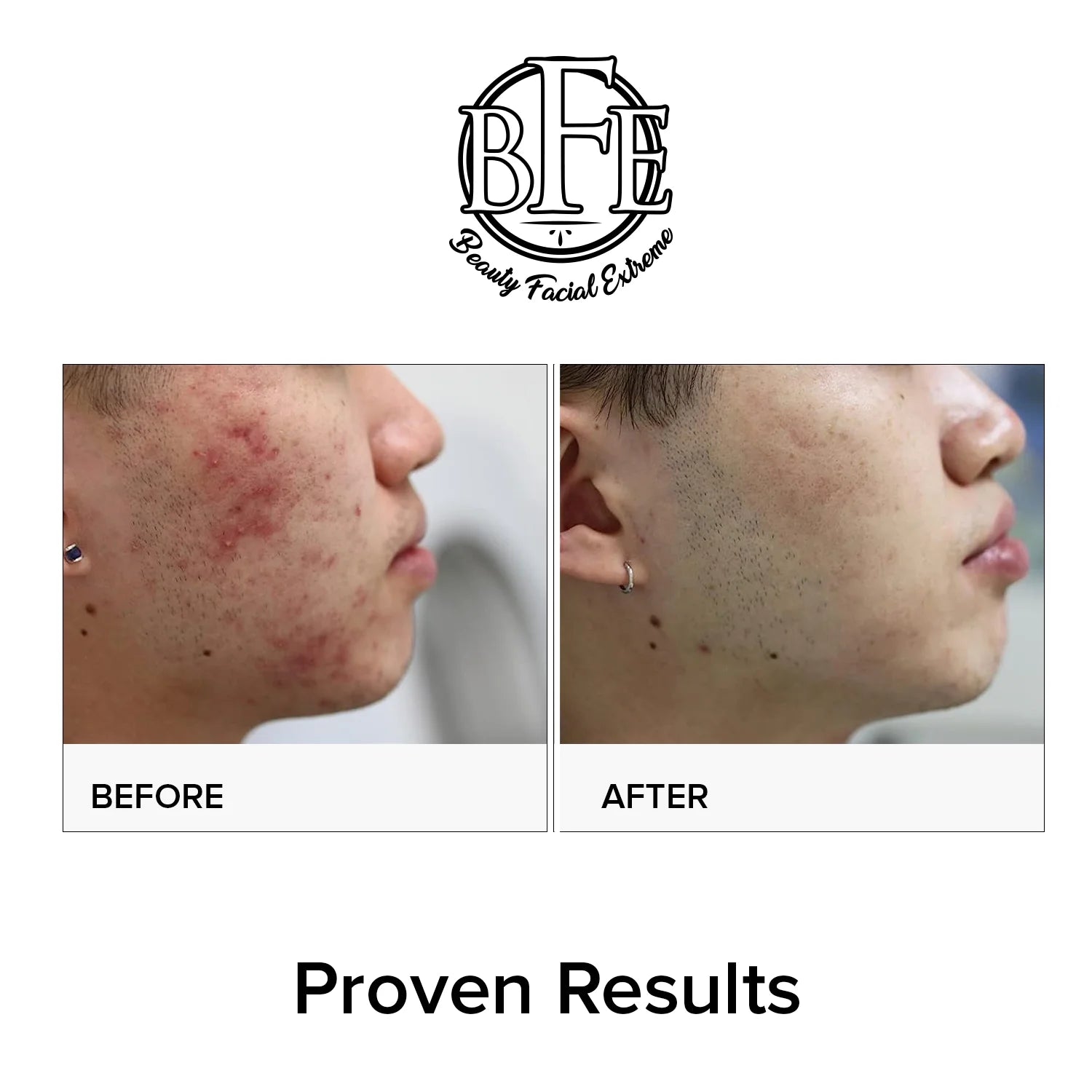 Acne Treatment Pads