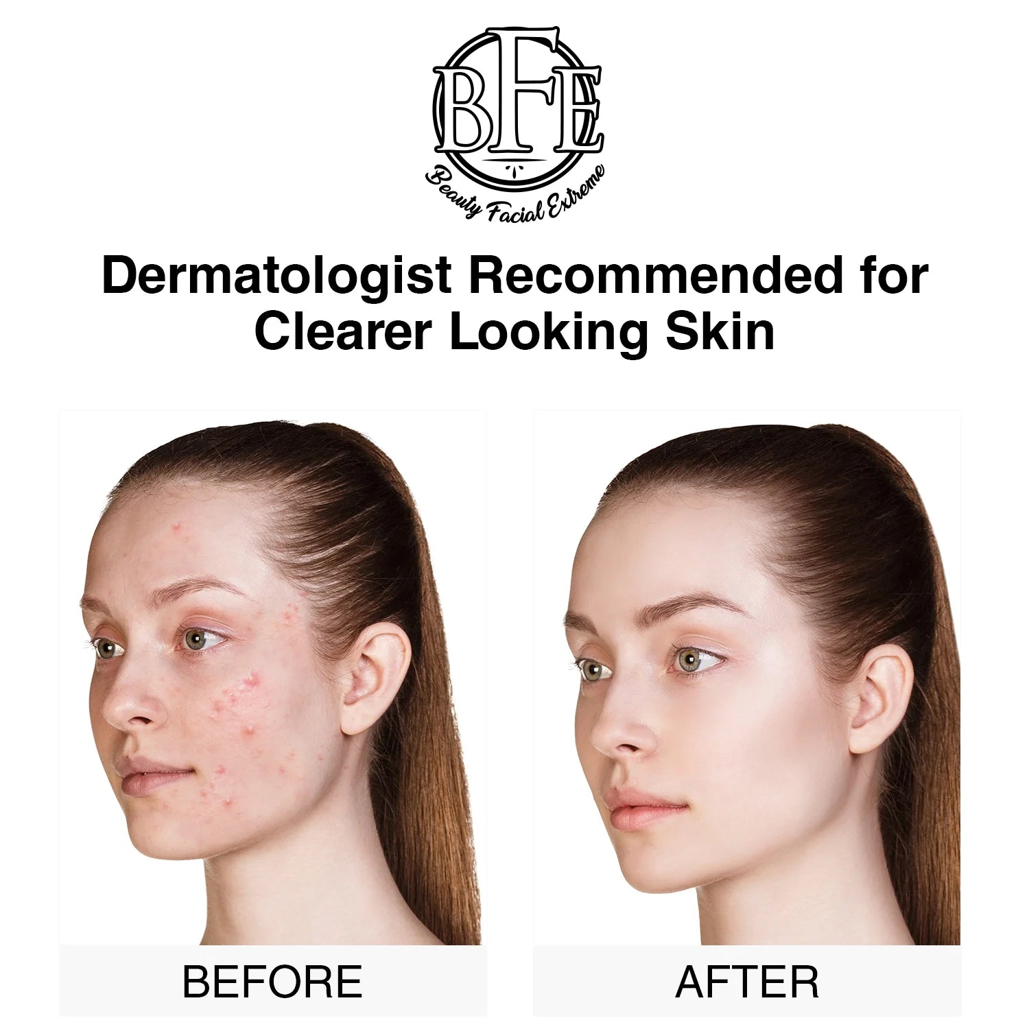 Acne Treatment Pads